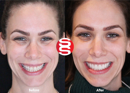 Porcelain Veneers